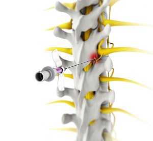 Radiofrequency Ablation